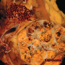 BLASTED PANCREAS - CARCINOMA [LP]